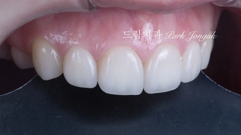 라미네이트 레이저 제거 재시술 재치료 자연스럽게