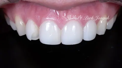 라미네이트 재시술, 레이저 제거로 안전하게 다시 시작하다