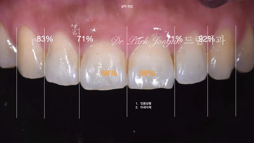 교정 후 무삭제 라미네이트