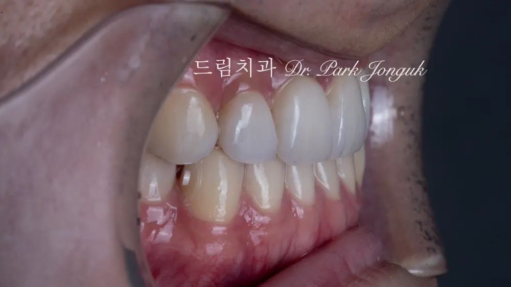 앞니 무삭제 라미네이트