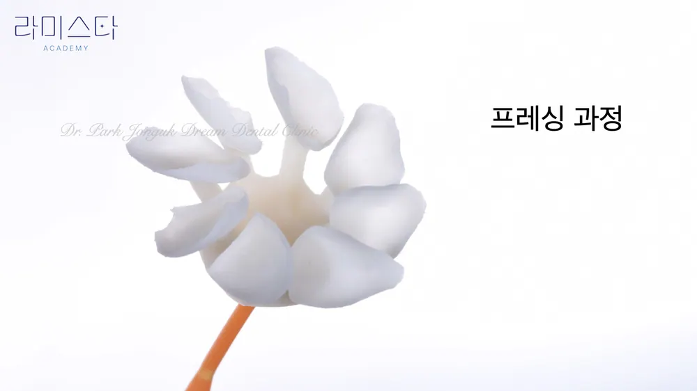 앞니 라미네이트 제작 과정 원데이방식과 핸드메이드 방식의 차이