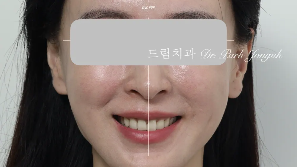 라미네이트 진단