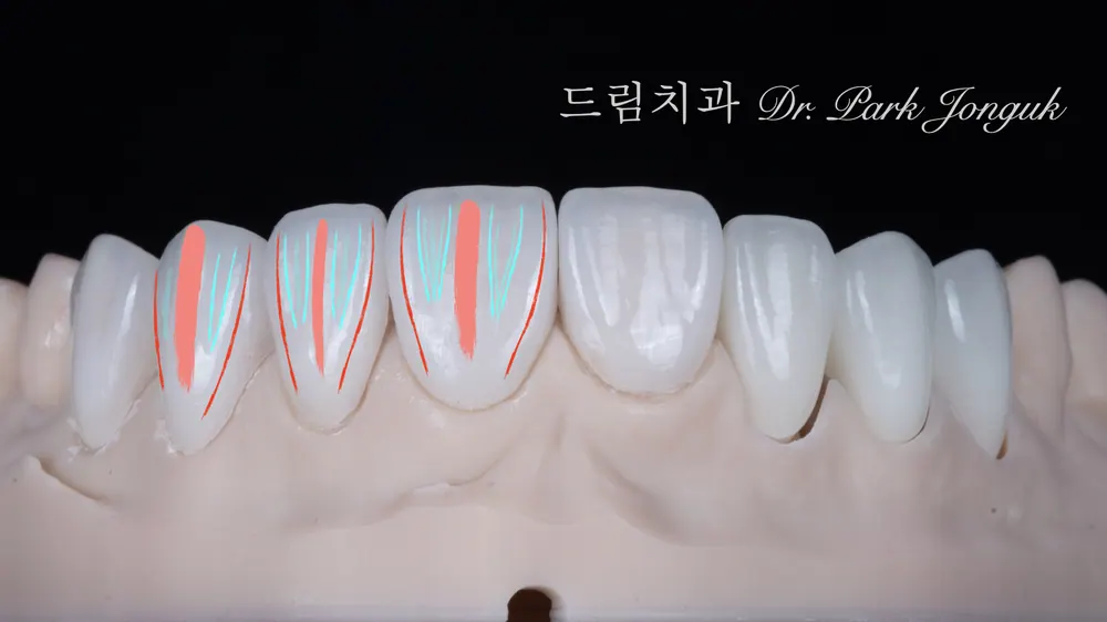 자연스러운 앞니 라미네이트의 구성요소