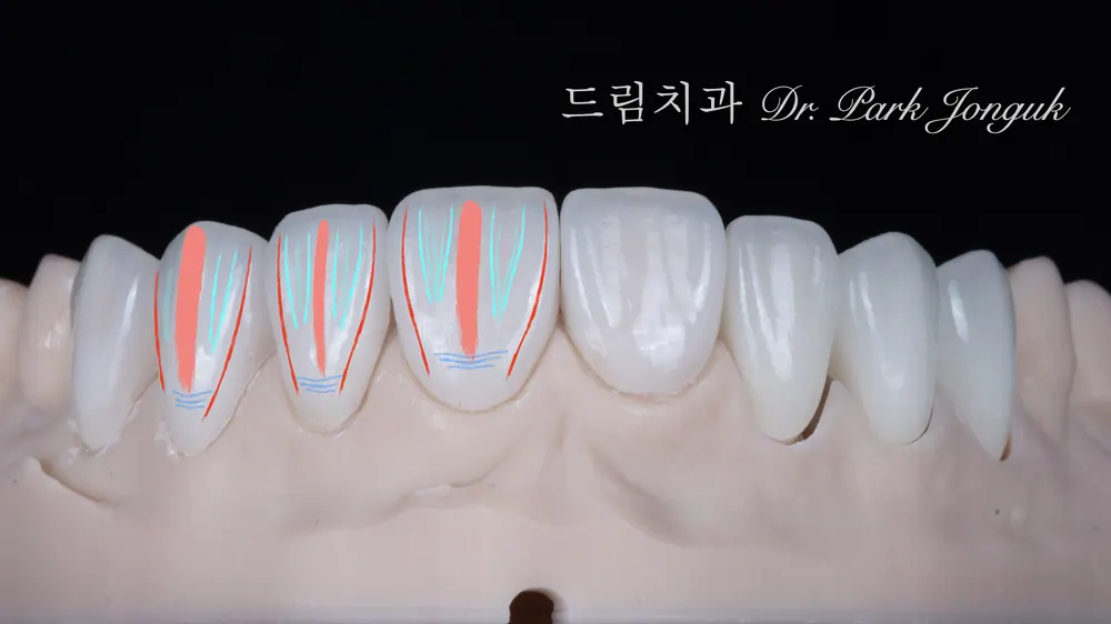 자연스러운 앞니 라미네이트의 구성요소
