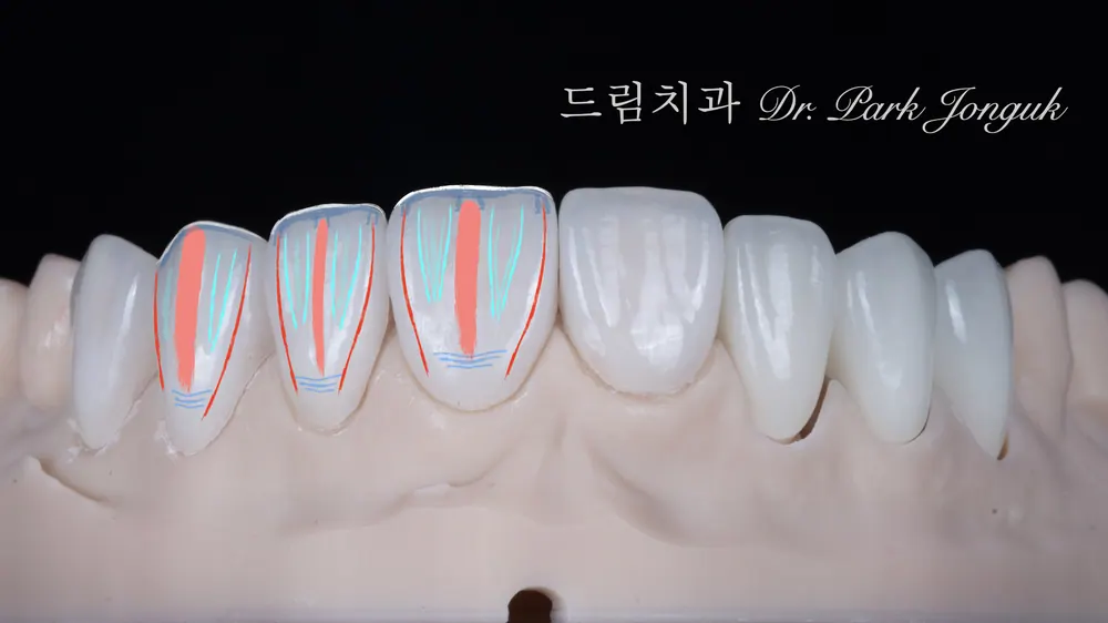 자연스러운 앞니 라미네이트의 구성요소
