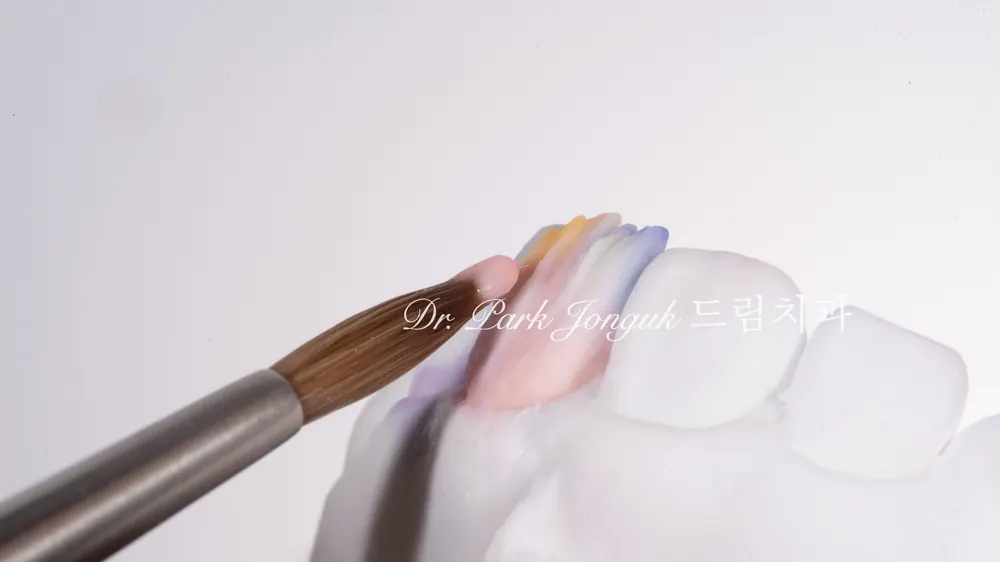 꼼꼼한 앞니 라미네이트 제작과정