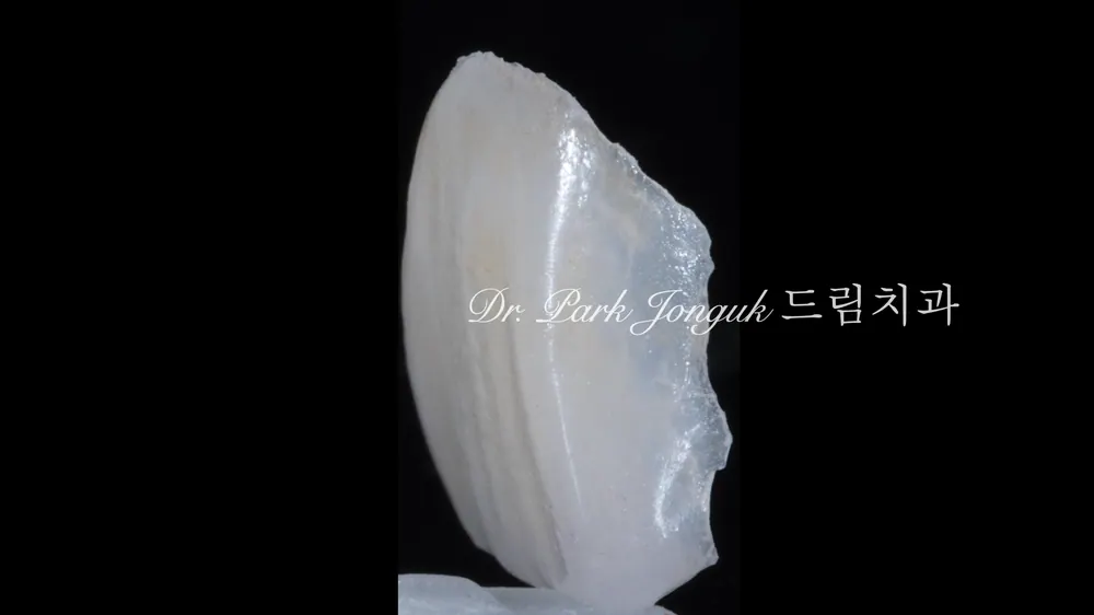 라미네이트 제작 후 모습