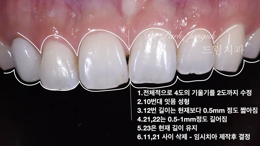 교정후에도 가지런하지 않은 치아에 대한 라미네이트 치료