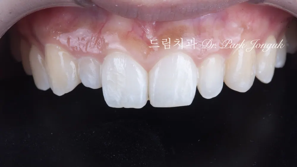 왜소치 무삭제 라미네이트
