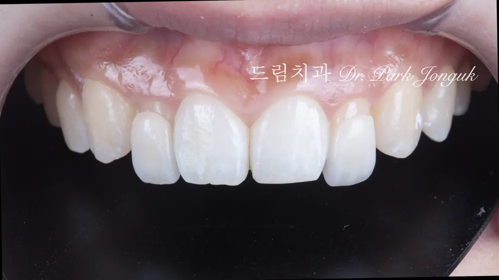 왜소치 무삭제 라미네이트