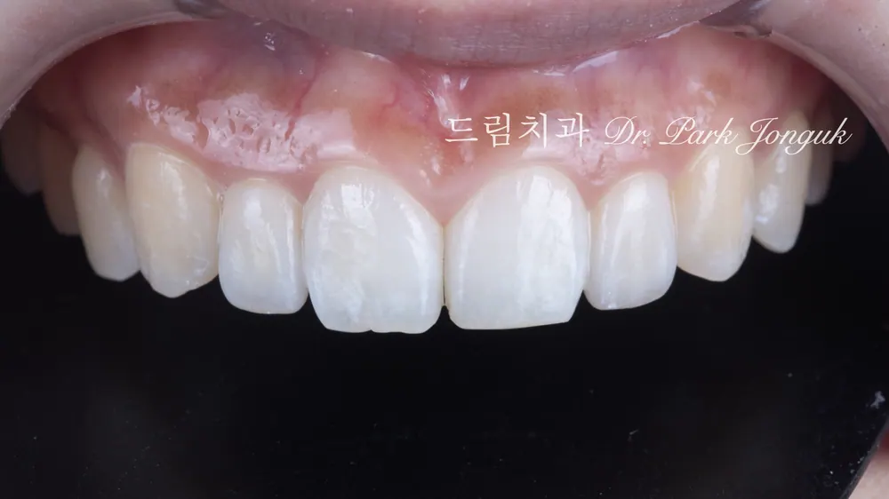 왜소치 무삭제 라미네이트