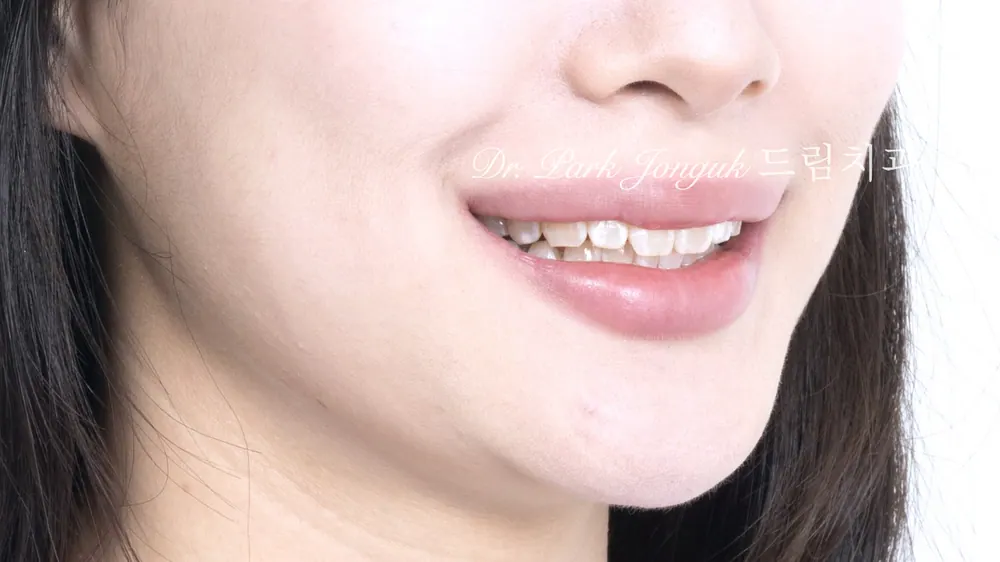 변색치아 얼룩치아 앞니 라미네이트