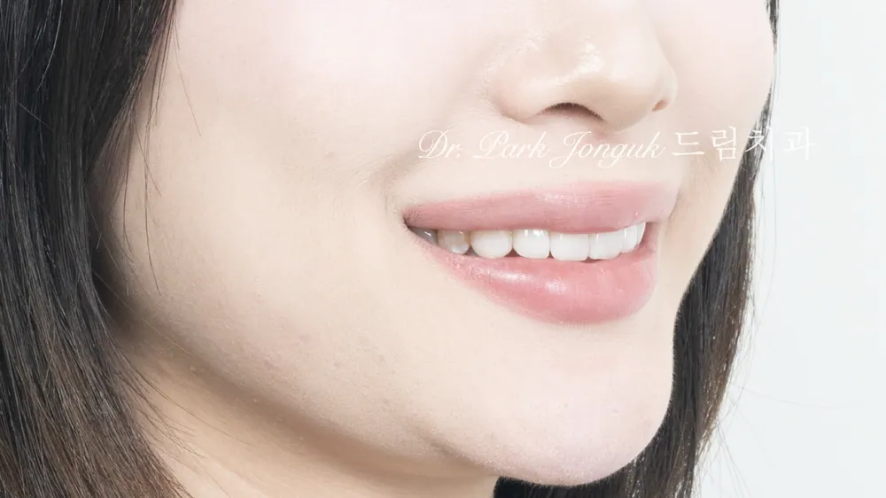 변색치아 얼룩치아 앞니 라미네이트