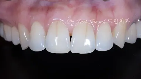 앞니 라미네이트 2개만? 라미네이트 잘하는 곳의 비밀