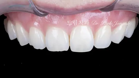 무삭제 라미네이트 가능한 조건 3가지, 실제 케이스로 보여드립니다
