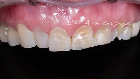 노화 치아 라미네이트, 50대 60대도 젊은 치아 가질 수 있습니다