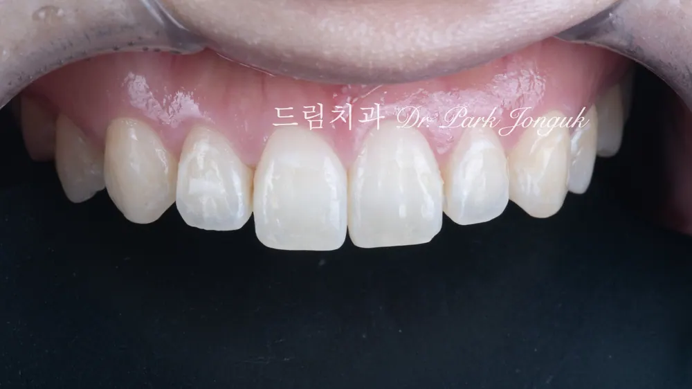 교정후 변색 무삭제 라미네이트
