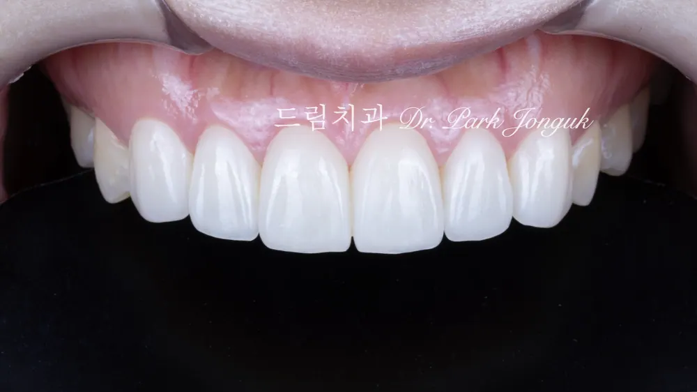 교정후 변색 무삭제 라미네이트
