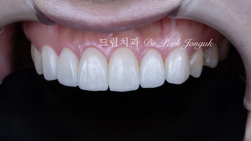 교정후 변색 무삭제 라미네이트