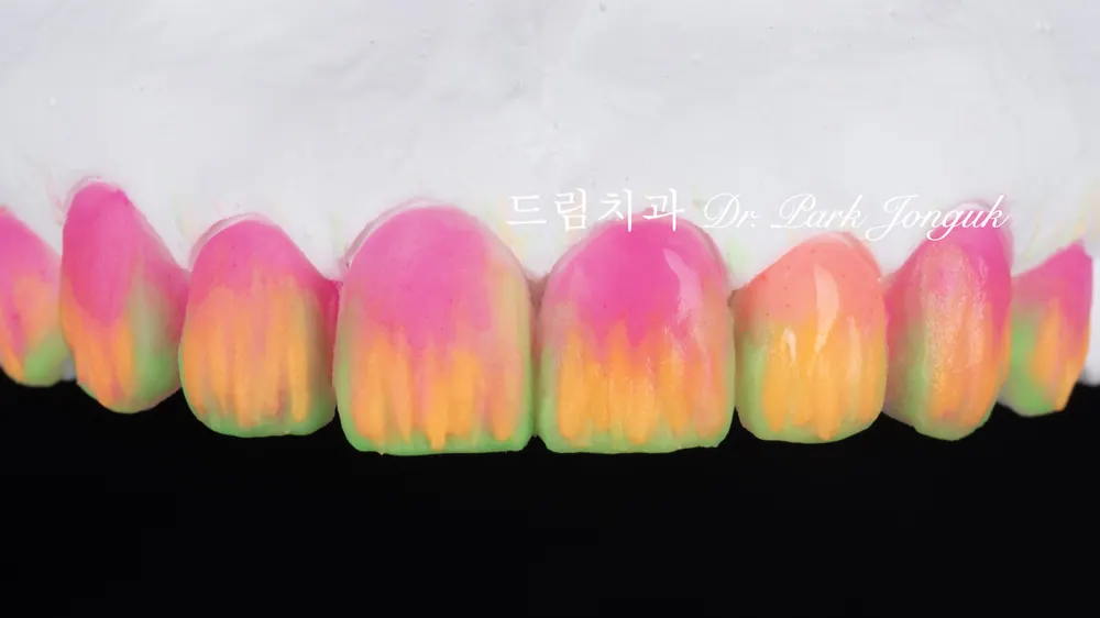 투명하고 디테일이 살아있는 자연스러운 라미네이트