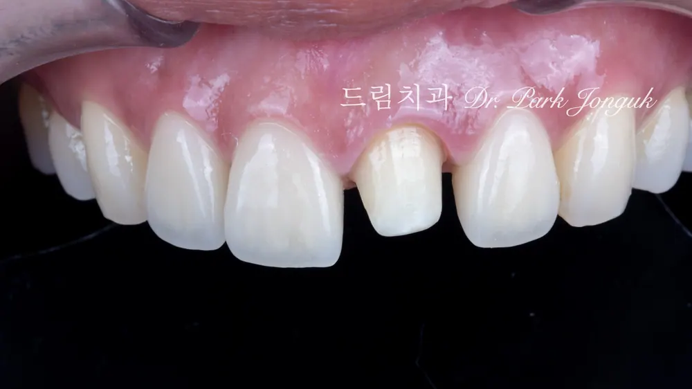 라미네이트 올세라믹 크라운 재시술 레이저 제거