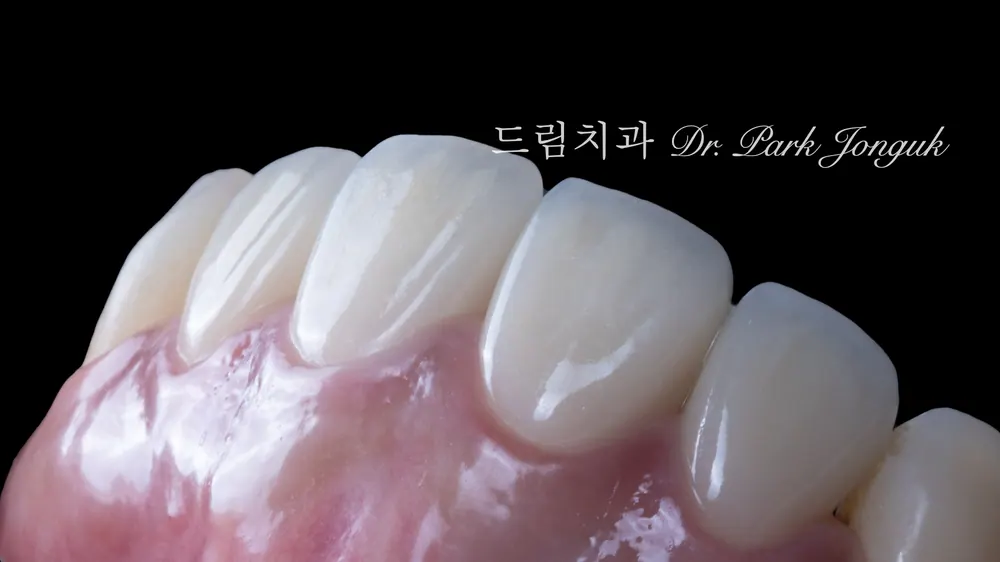 라미네이트 올세라믹 크라운 재시술 레이저 제거