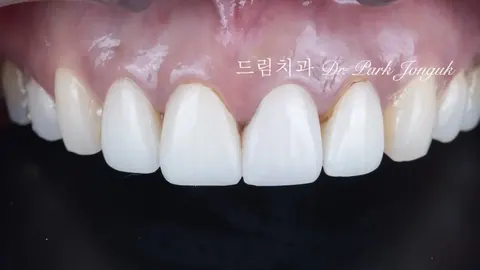 라미네이트 크라운 재시술, 어색한 치아를 자연스럽게 바꾸다