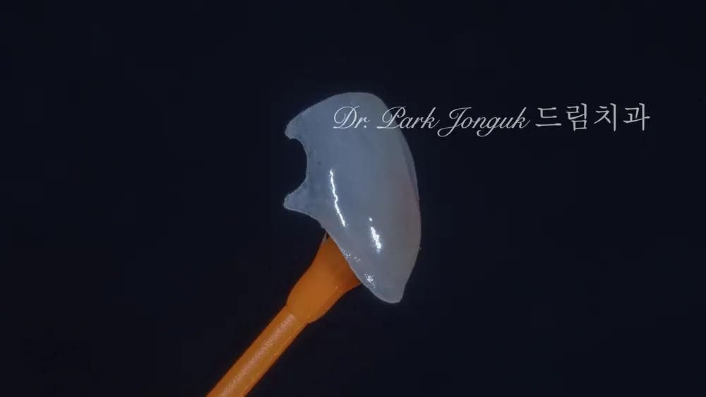 교정후 옥니, 블랙 트라이앵글의 무삭제 라미네이트