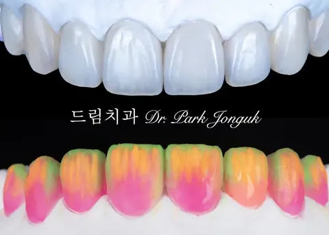 라미네이트 가격, 왜 치과마다 다를까요?