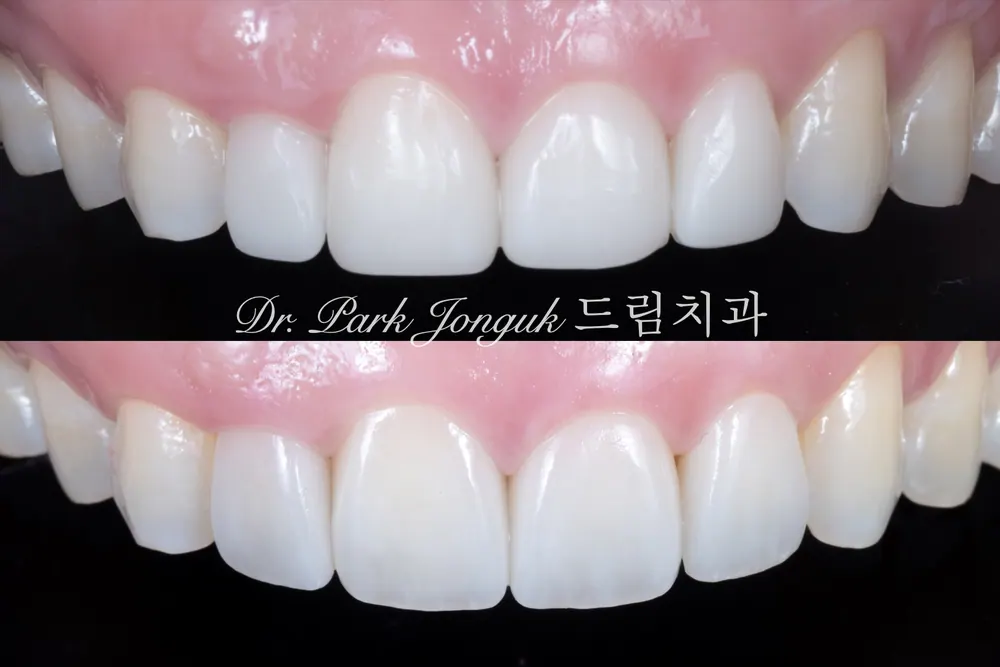 치료받은지 얼마 안된 라미네이트인데 심미적인 목적으로 재치료 받은 케이스
