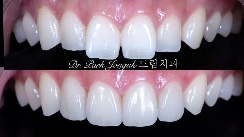 교정과 라미네이트 치료에서 고민하다가 치료 기간과 비용으로 라미네이트를 선택한 케이스