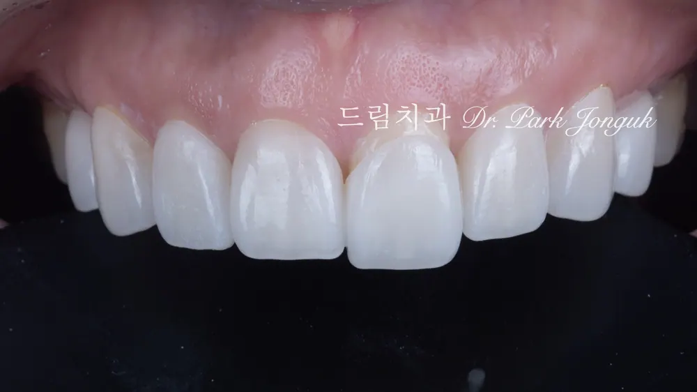 라미네이트 부착 직전 · 치아 색 비교 과정