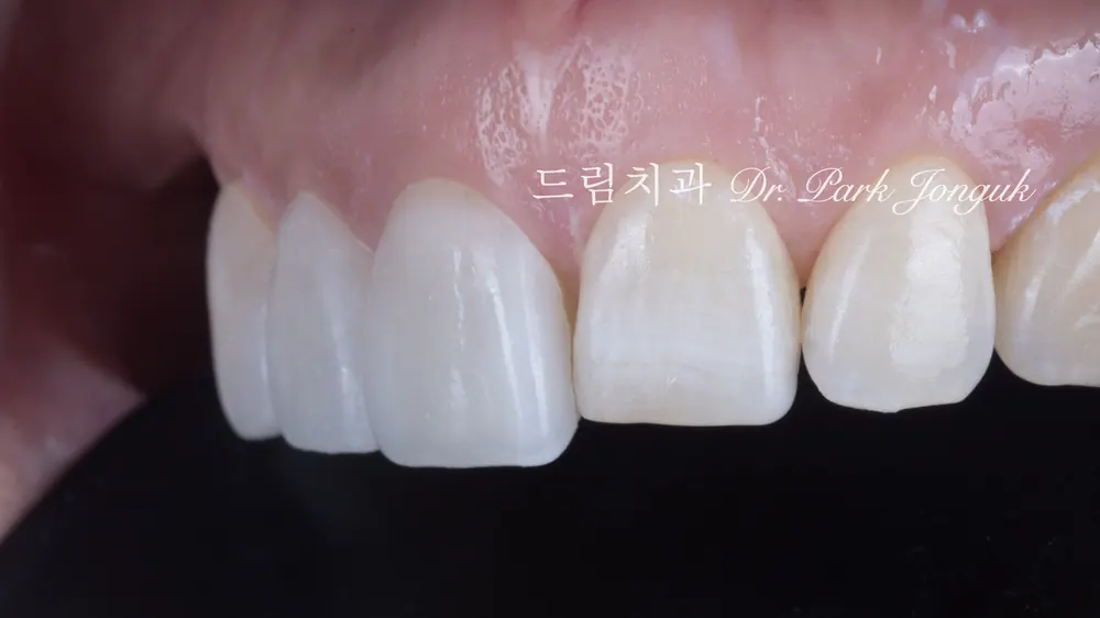 무삭제 라미네이트