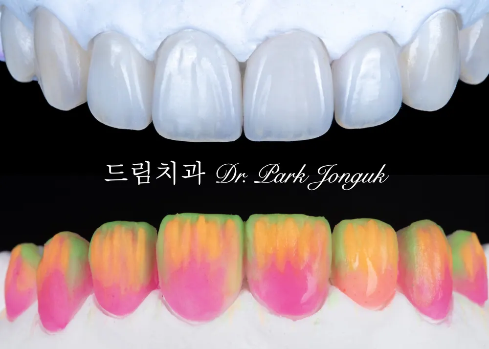 빌드업을 통한 자연스러운 라미네이트 제작