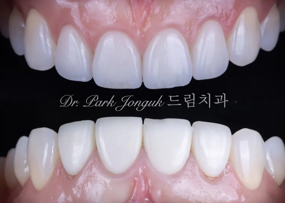 불투명하고 어색한 라미네이트를 투명감 있게 재시술 한 케이스
