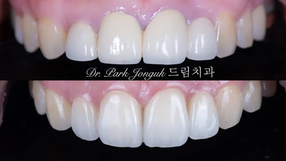 부자연스러운 앞니의 재시술