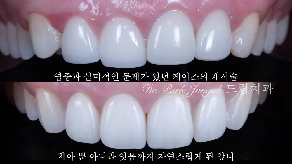 장기적인 계획으로 염증과 잇몸 모양까지 수술 없이 해결한 케이스