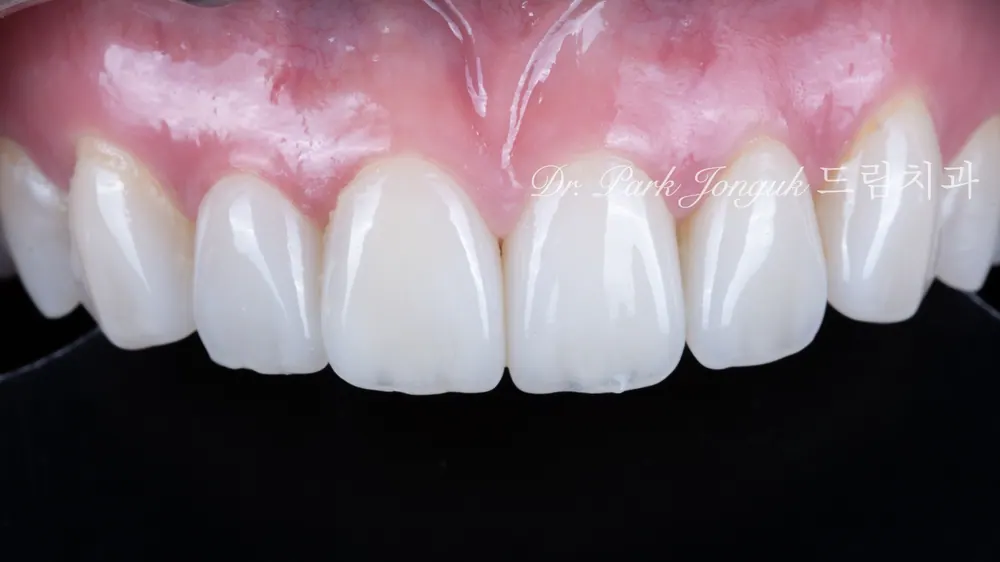매년 정검으로 10년 가까이 아무 문제 없는 라미네이트