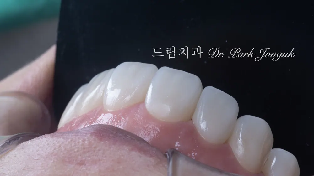 무삭제 라미네이트. 자연스럽고 아름다우면서도 잇몸과 잘 조화가 되어있음.