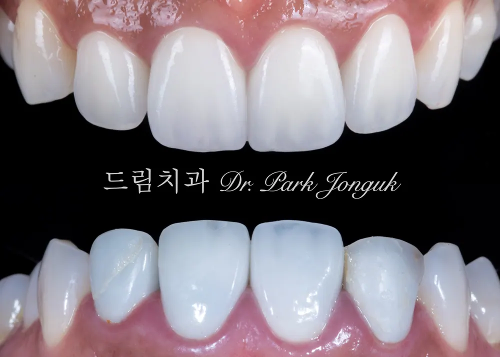 파절 탈락 등으로 재시료를 한 케이스. 습관이 영향을 주기도 합니다.