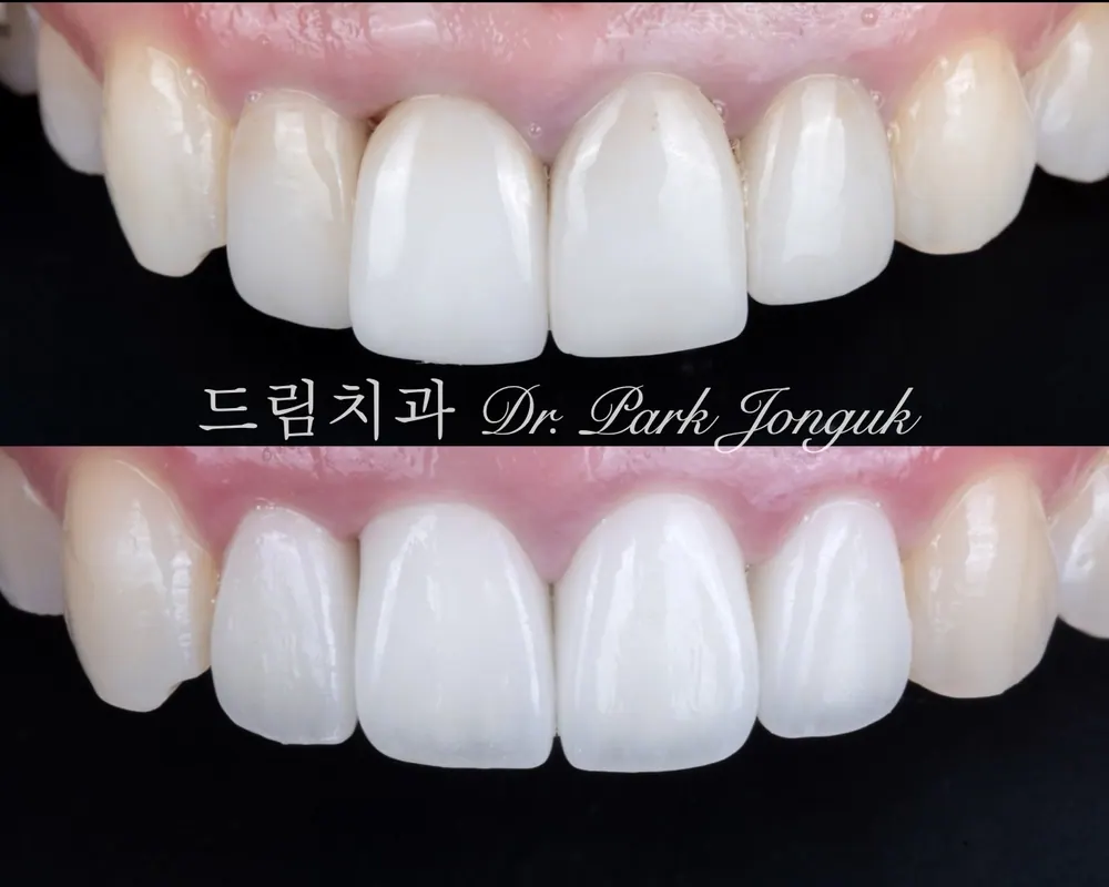 잇몸의 변화가 생겨서 재치료 한 케이스.