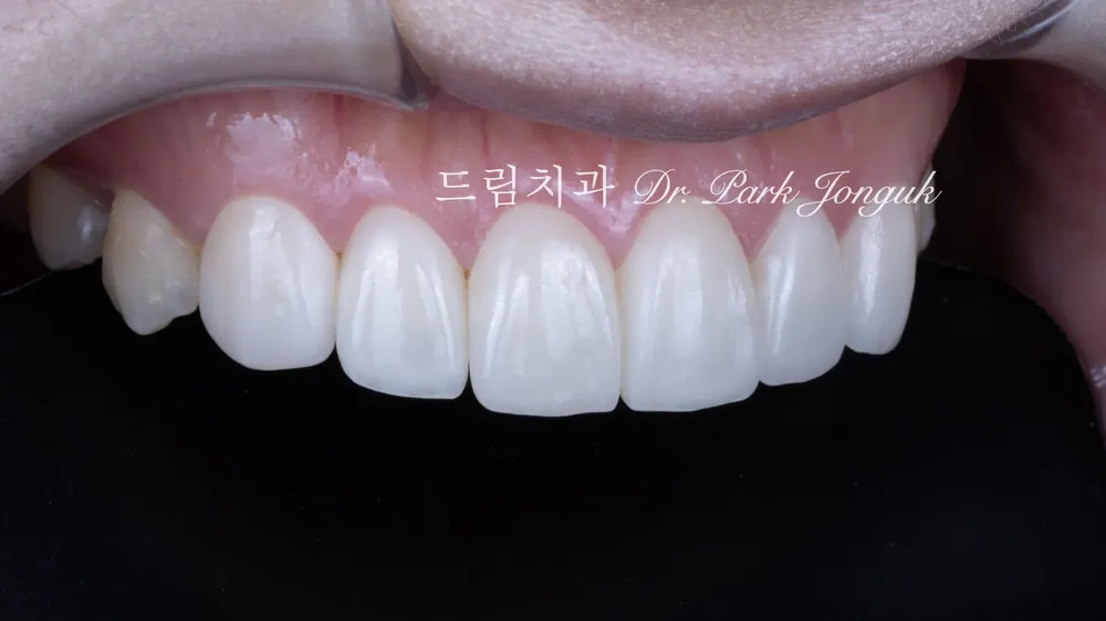 무삭제 라미네이트, 자연스러운 치아의 표현이 잘 담겨있음.