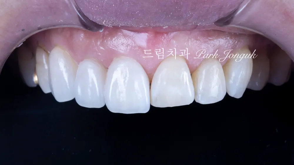 현재 치아와의 변화를 잘 볼 수 있는 무삭제 라미네이트 세팅과정