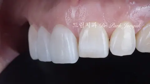 무삭제 라미네이트의 진실 - 광고와 임상 현실의 차이