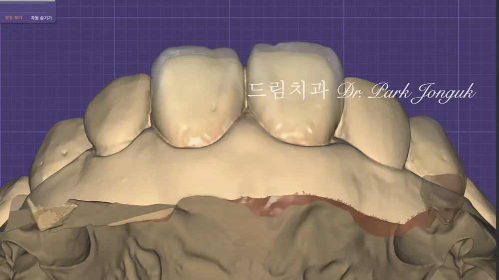 디테일한 라미네이트 진단과정