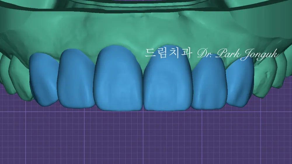 디테일한 라미네이트 진단과정