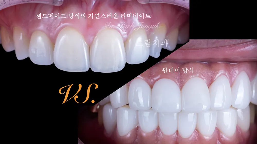 자연스러운 라미네이트와 인공적인 라미네이트
