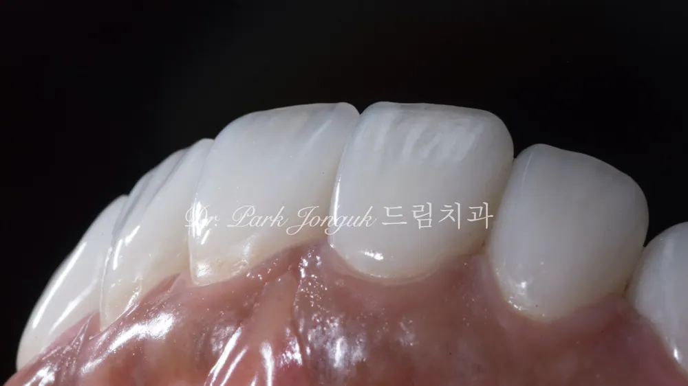 잇몸 라인과 잘 조화가 되는 라미네이트