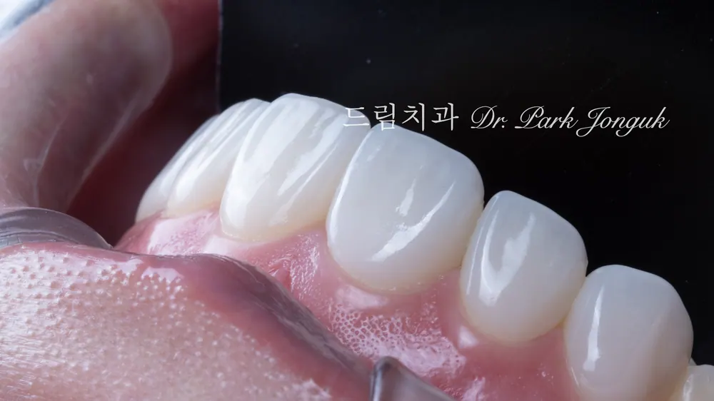 자연스러운 형태까지 표현된 라미네이트