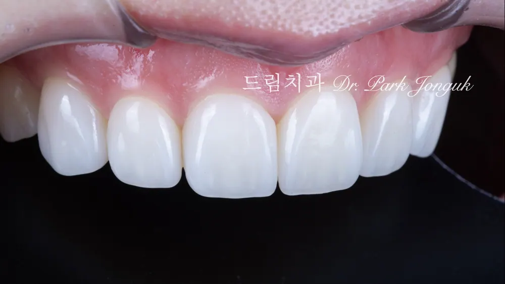 다양한 색과 투명감의 표현이 돋보이는 무삭제 라미네이트